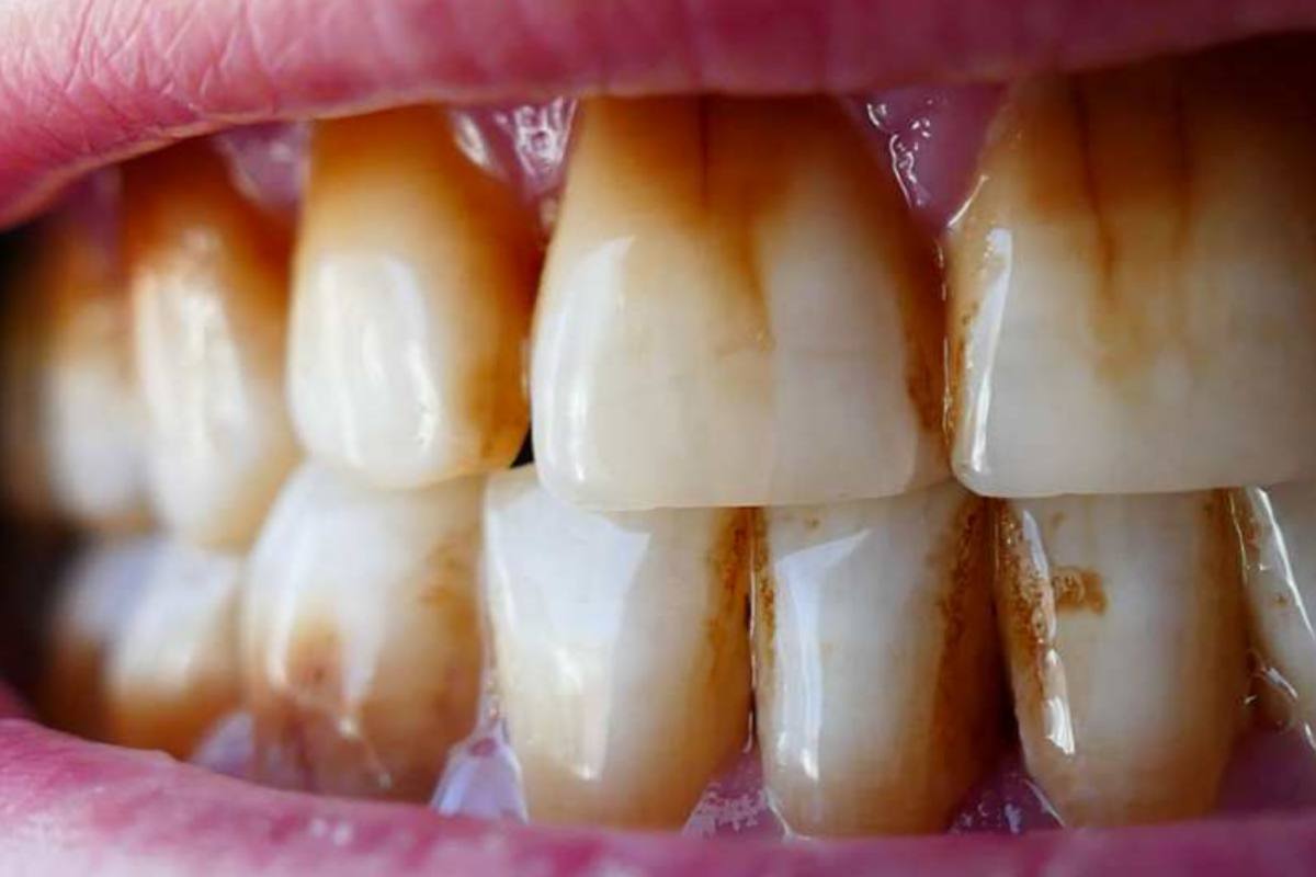 Denti ingialliti esiste una soluzione senza andare dal dentista